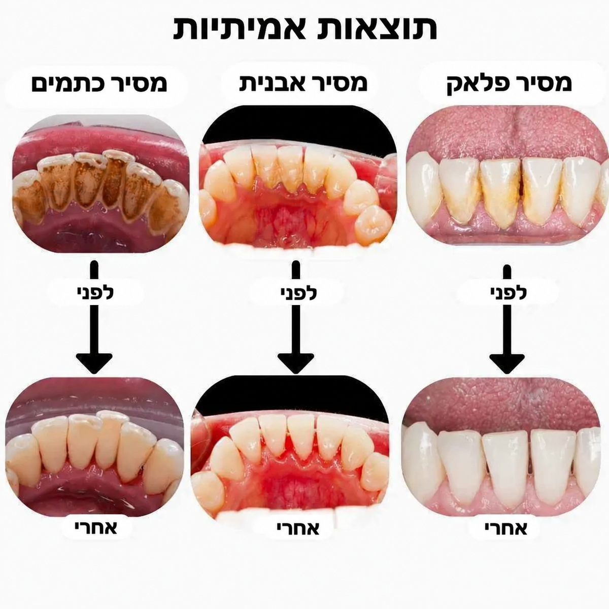 ELYMONT מנקה שיניים חשמלי